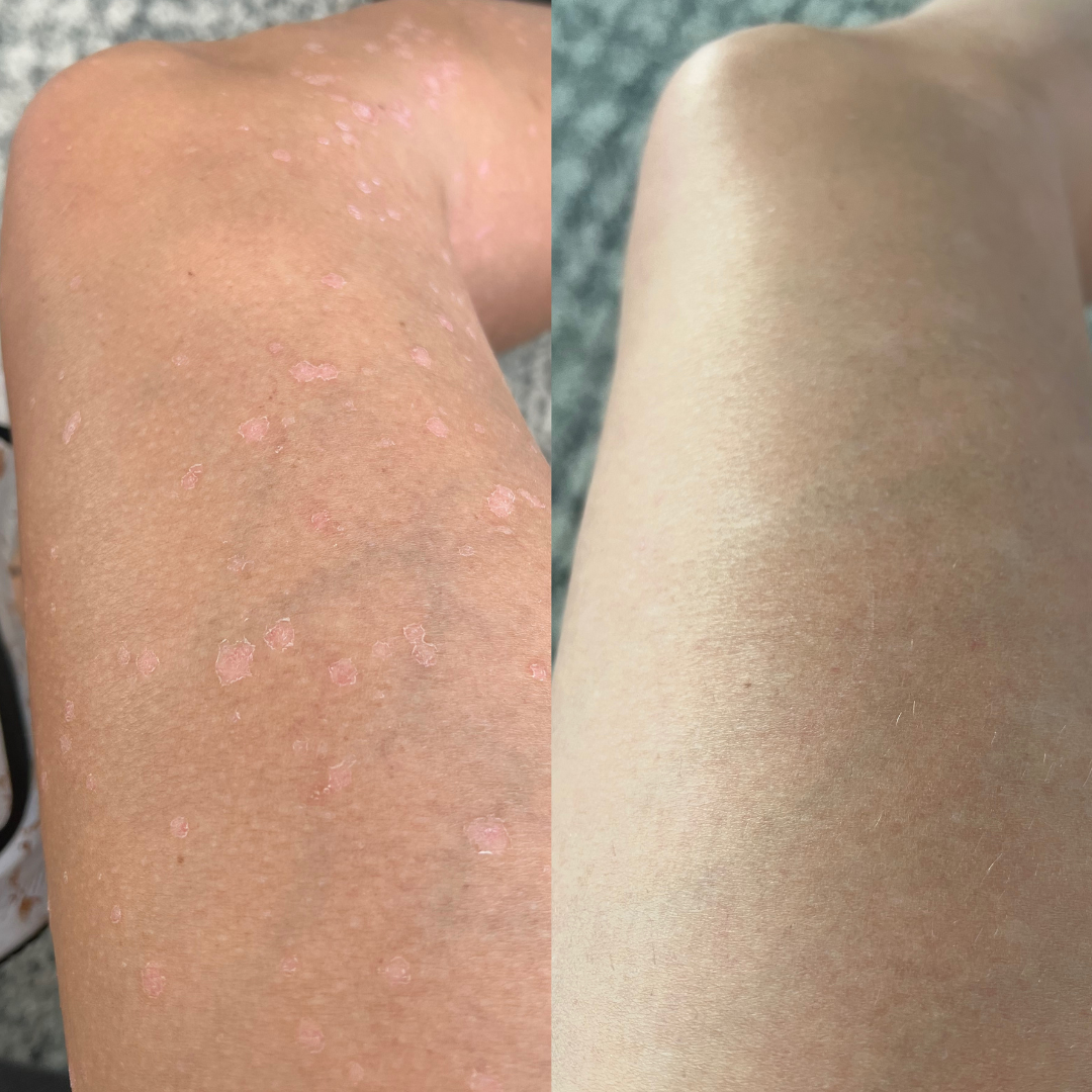 Psoriasis. before and after